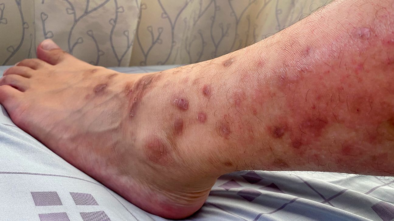 Dermatitis On The Leg. 1296x728 Slide1 