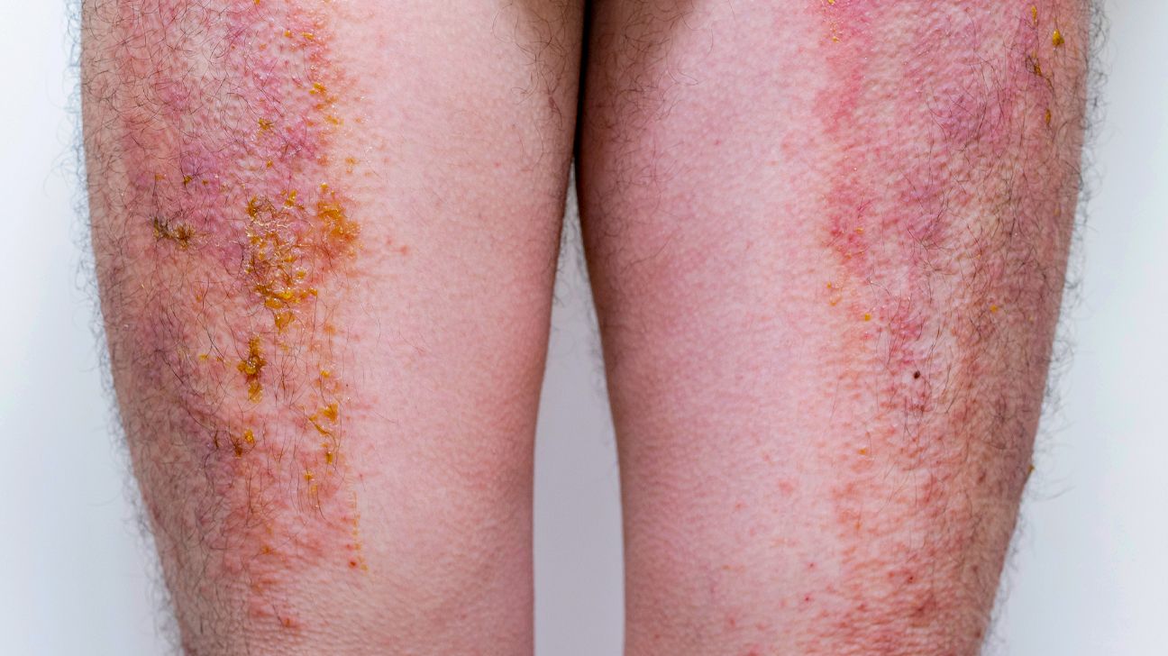 contact dermatitis legs