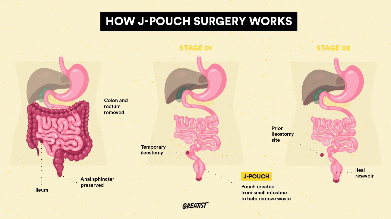 jpouch surgery diagram