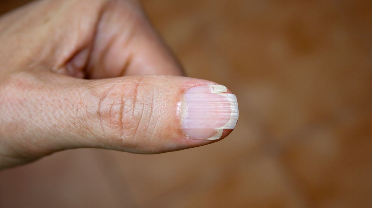 What Causes Ridges & Splitting On Your Nails? | Dr.'s REMEDY Nail Care