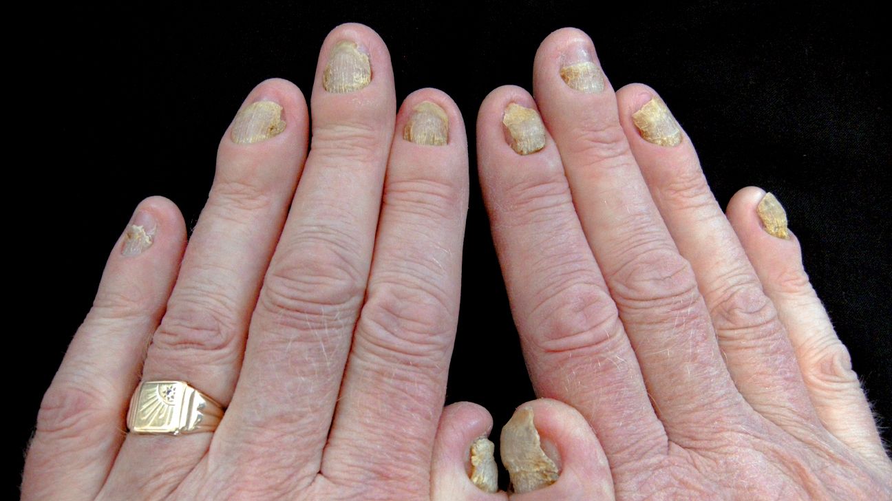 Yellow Nail Syndrome in Association with Protein-Losing Enteropathy in a  Diabetic Patient