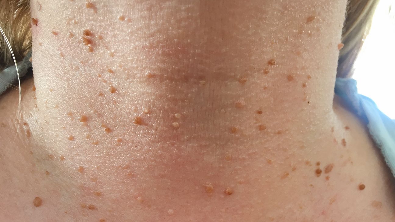 Acrochordon or skin tag near armpit Stock Photo
