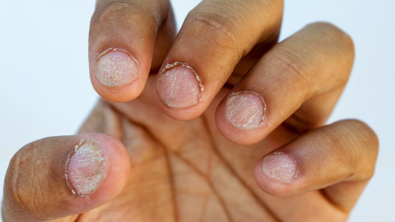 What Are These Nail Changes That Appeared Simultaneously in 3-Year-Old  Twins?