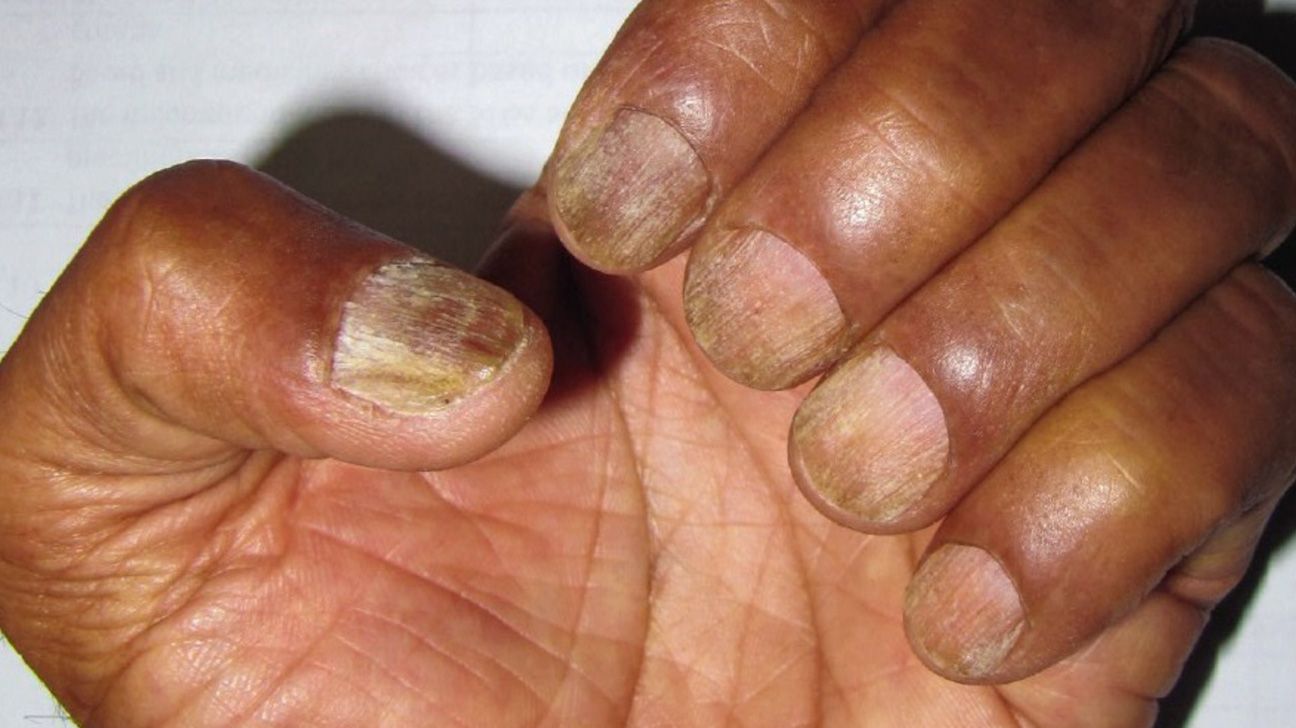 Trachyonychia, or ridges or splitting down the length of the nails