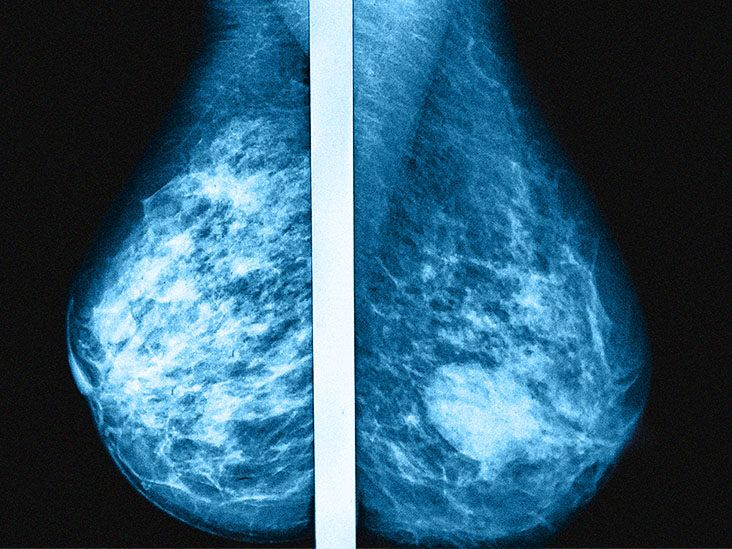 Breast Density: What it is and What it Means to You, Breast Cancer Program