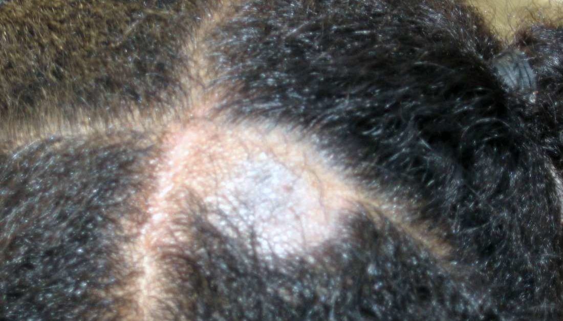 Tinea Capitis Scalp Ringworm Causes Symptoms And Treatments 2038