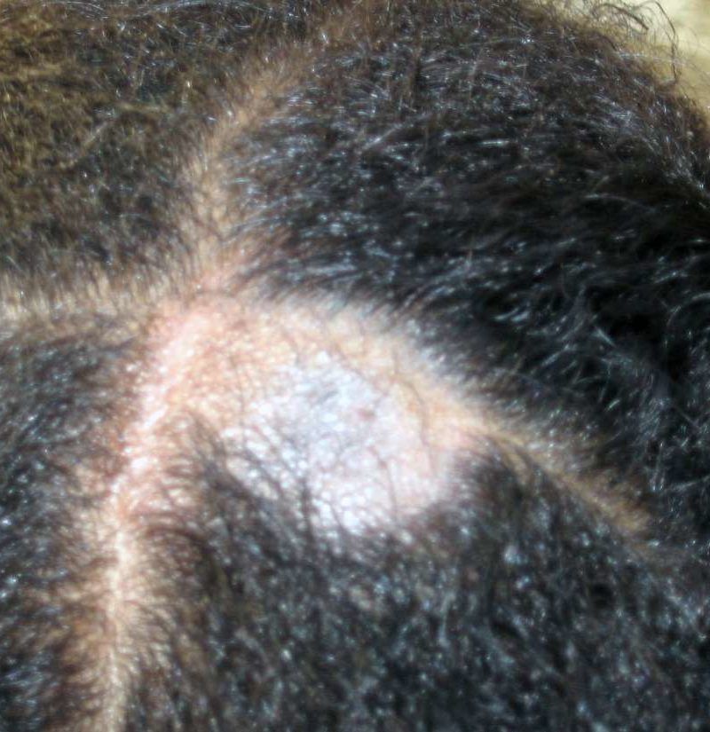 Tinea Capitis Scalp Ringworm Causes Symptoms And Treatments 3302