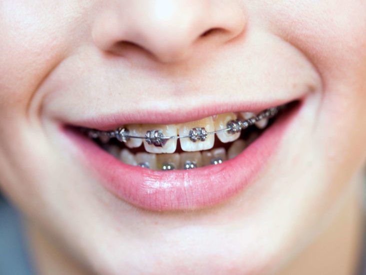Do braces hurt? What to expect when you get braces