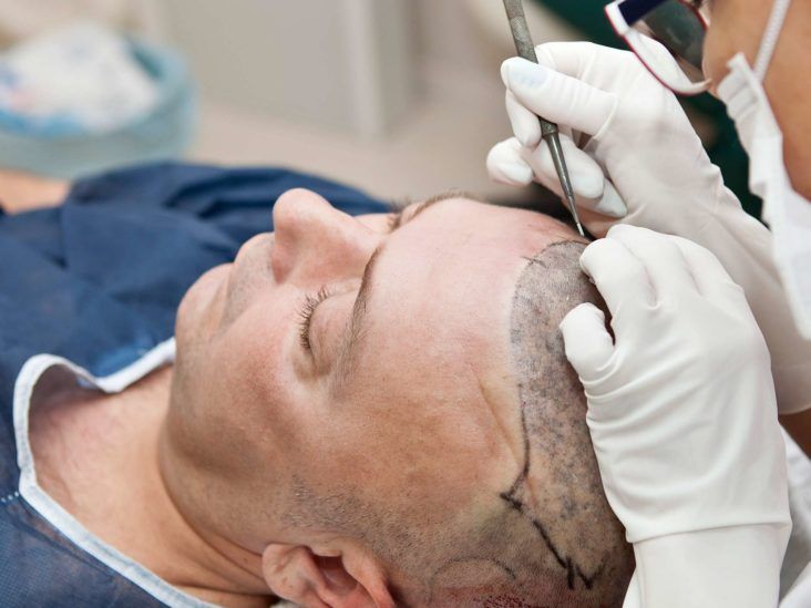 Do hair transplants work? Types, side effects, and recovery