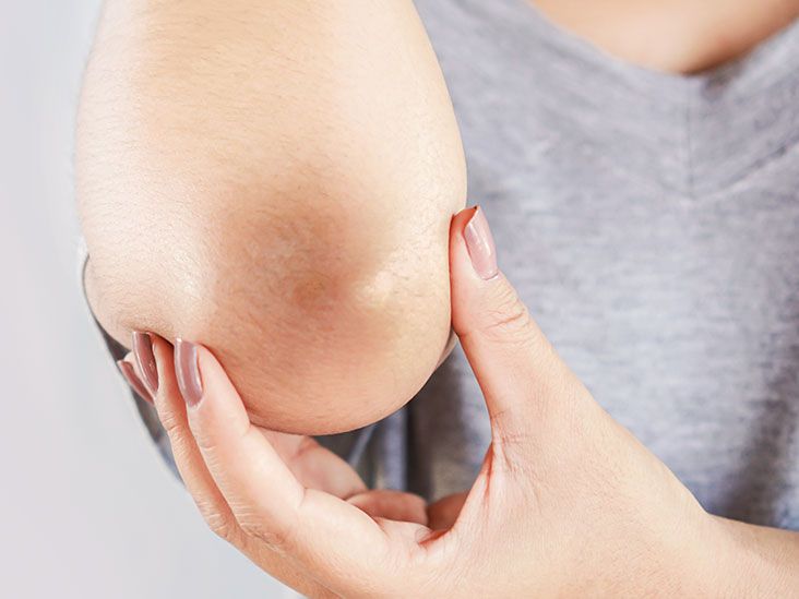 Dark elbows: Causes, remedies, and treatment