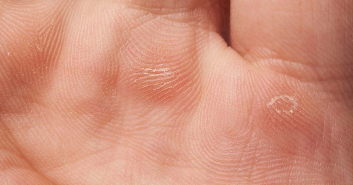 Epidermolysis bullosa: Effects, types, and symptoms