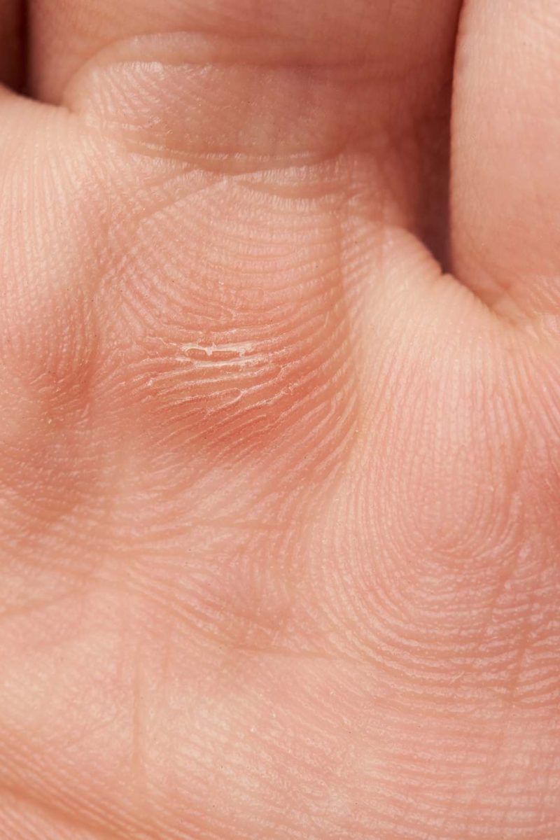 Epidermolysis bullosa: Effects, types, and symptoms