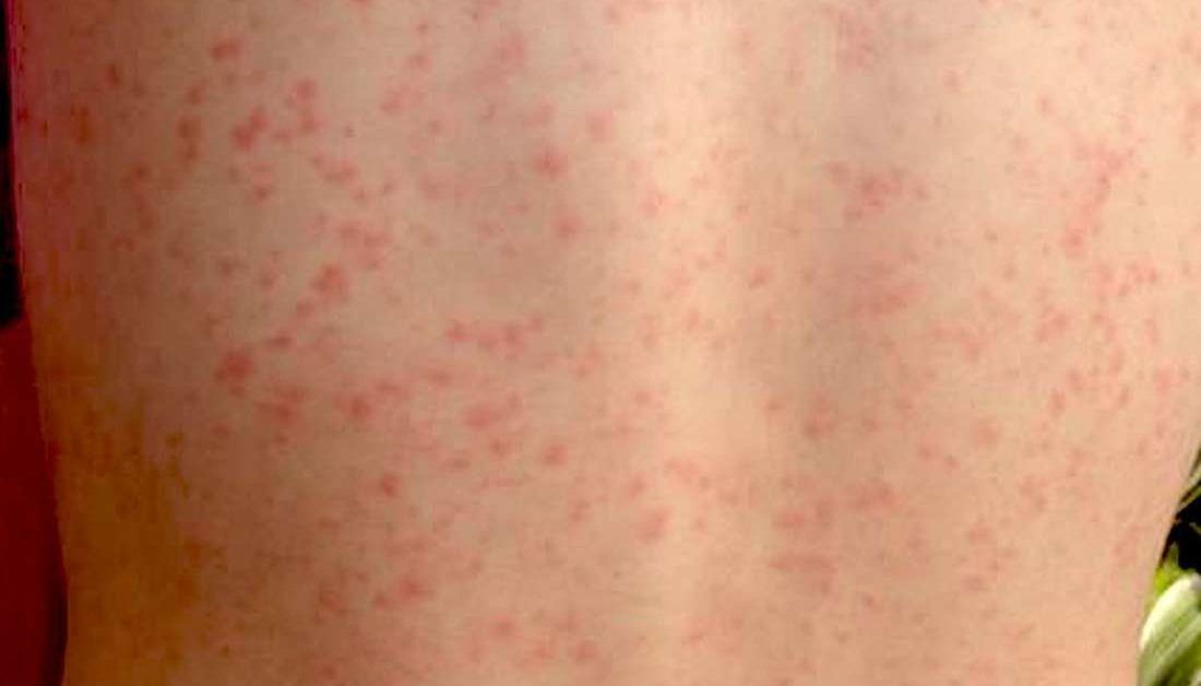 What is Scarlet Fever? - First Aid for Free
