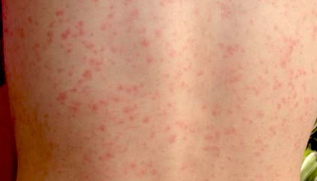 Scarlet fever Information