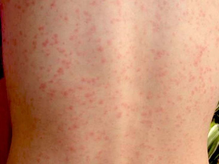 Information about Scarlet Fever, Nexles