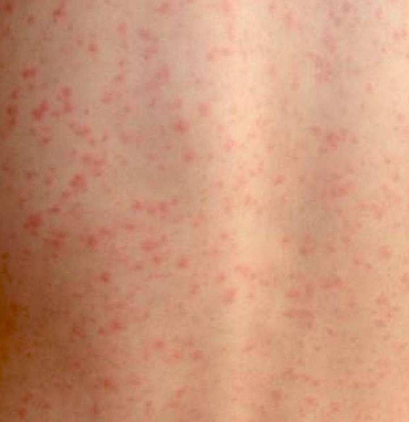 Scarlet fever Information