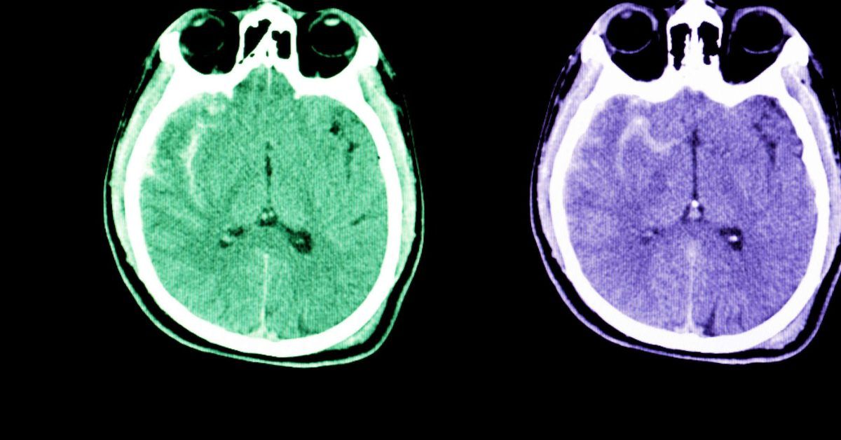 Subarachnoid Hemorrhage Symptoms Causes And Diagnosis