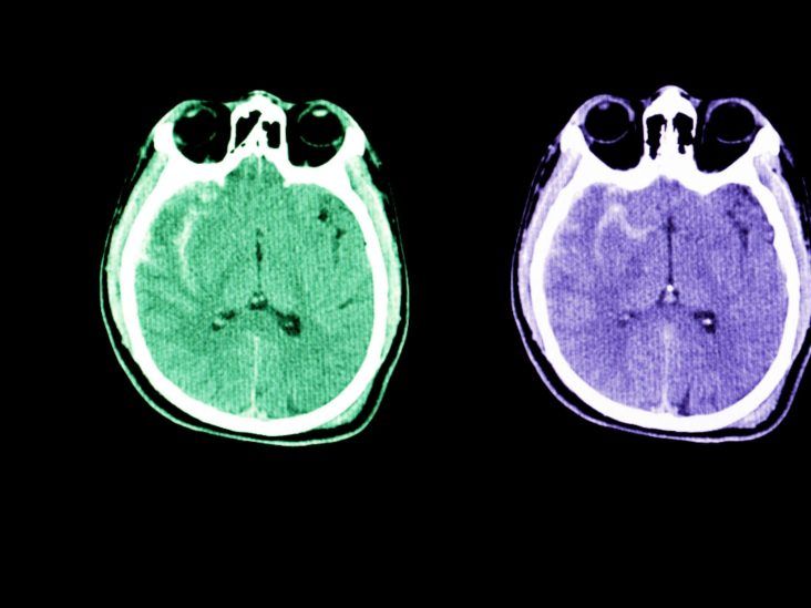 Subarachnoid Hemorrhage (SAH) - Brain, Spinal Cord, and Nerve