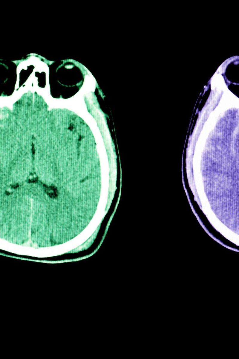 Subarachnoid Hemorrhage Symptoms Causes And Diagnosis