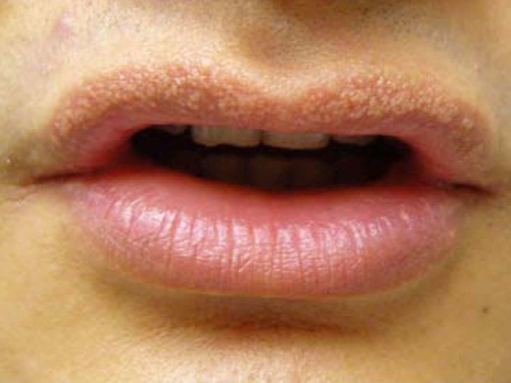 melanotica labial cancer manchas negras en los labios Manchas negras en los labios: 13 causas y remedios