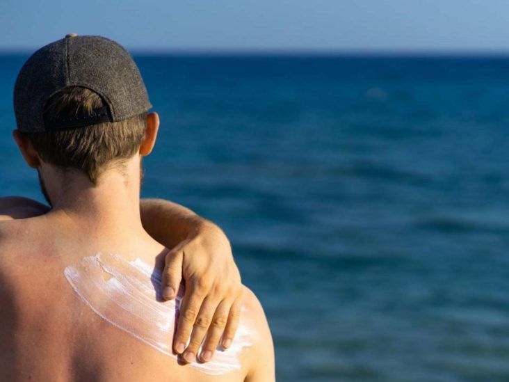 Sunburn: Treatments, home remedies, and prevention