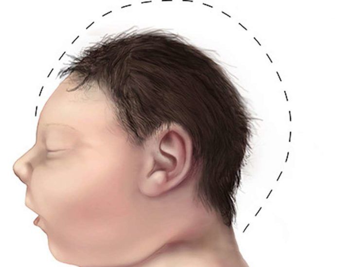 people with lissencephaly