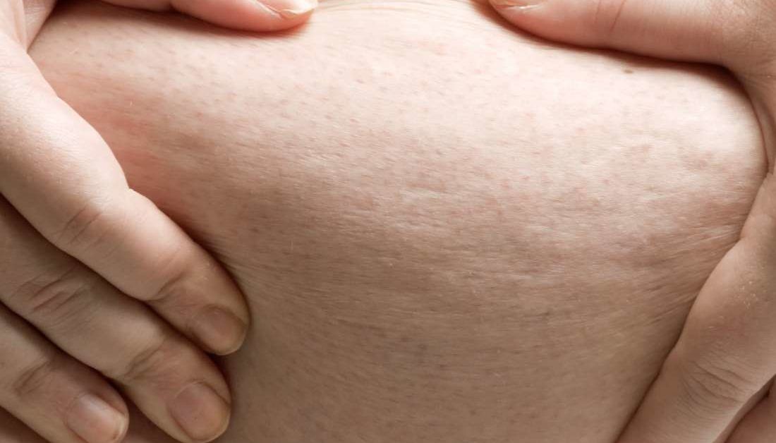 Peau d'orange Causes and treatment