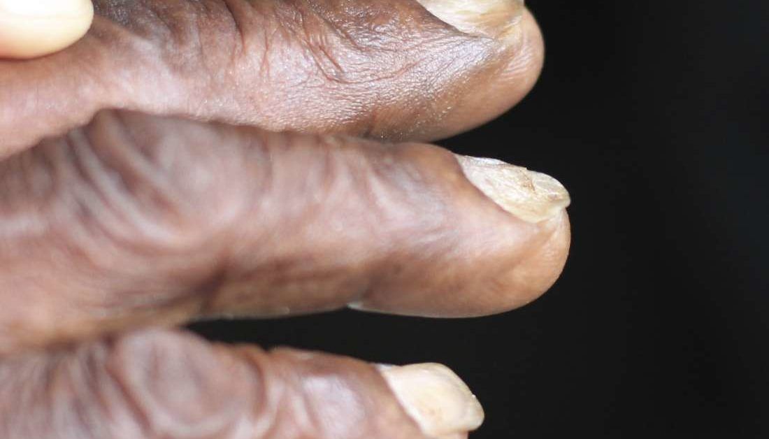 Ridges in Fingernails: Causes and Treatments