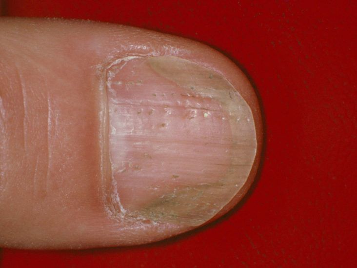 White Spots and Vertical Ridges on the Fingernails Stock Photo - Image of  calcium, diseases: 92853524