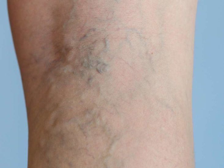 Varicose veins and support stockings 