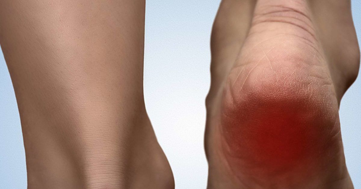 Heel spur: Symptoms, causes, diagnosis and treatments