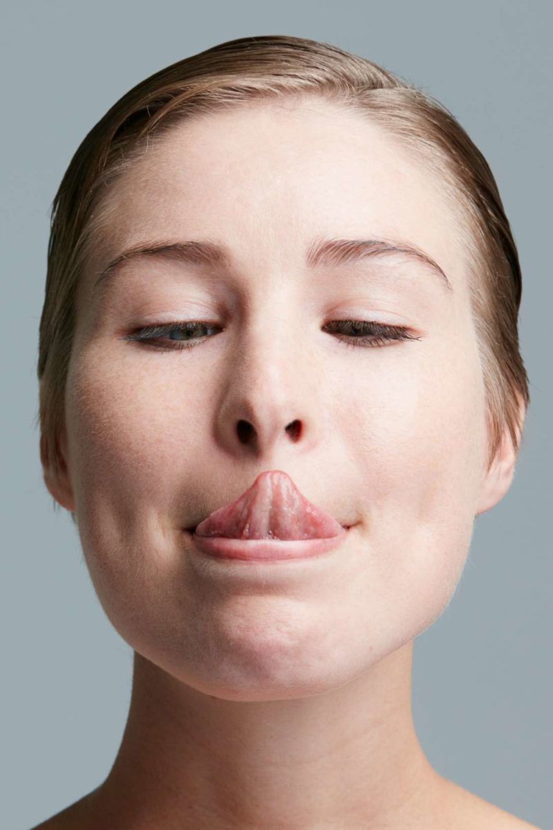 Scalloped tongue Causes, symptoms, and treatment