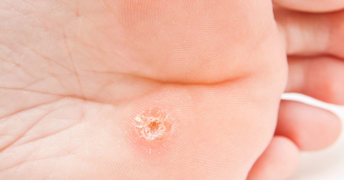 Hyperkeratosis: Causes, symptoms, and treatment