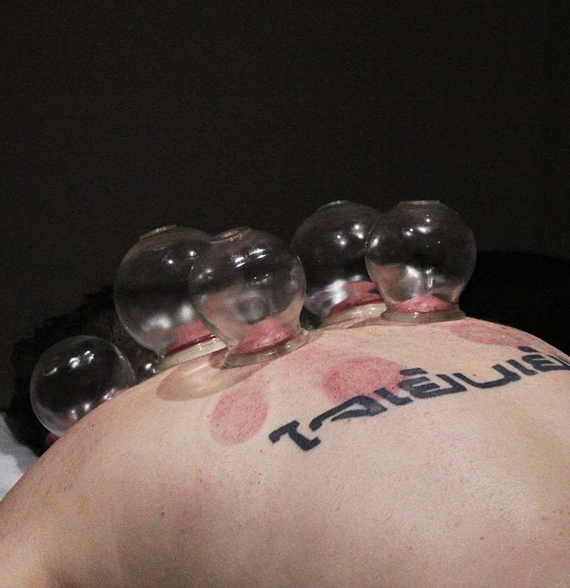 Cupping: Is it as painful as it looks?