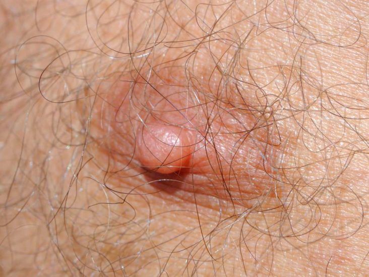 Fissure of the nipple - Wikipedia
