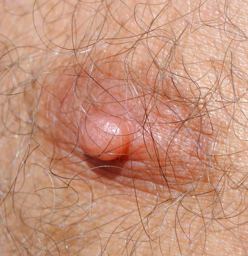Third (supernumerary) nipple: Types, causes, and removal