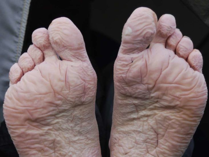 Midfoot Pain - Symptoms, Causes, Treatment and Rehabilitation