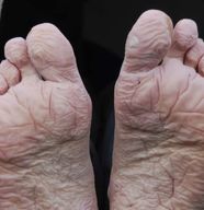 Trench Foot Symptoms Causes Treatment