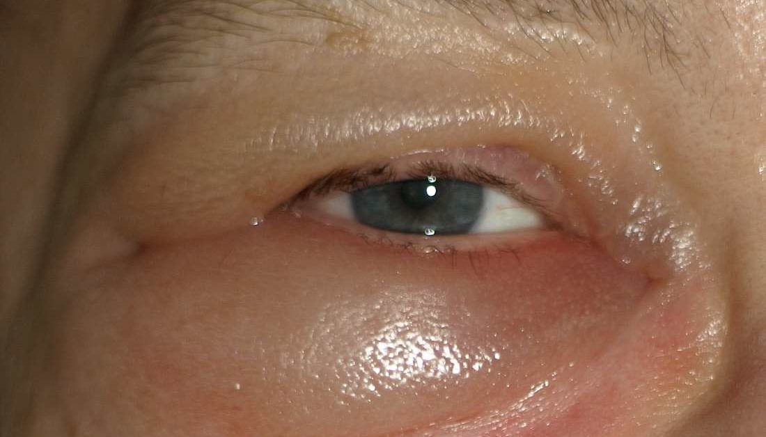 severe allergic reaction eye swelling