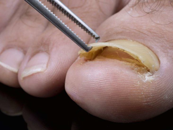Skin Infection Around Fingernails and Toenails