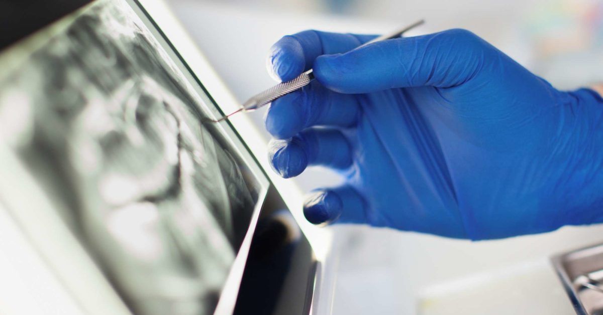 Periodontal (gum) surgery Preparation, what to expect, and recovery