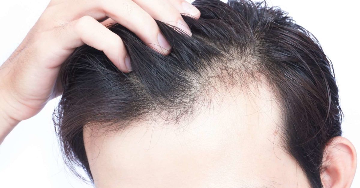 Scalp Yeast Infection: Symptoms, Causes, Treatment, and More