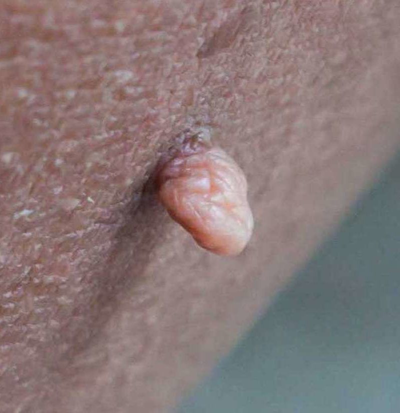 Friction blister on vag lips discount