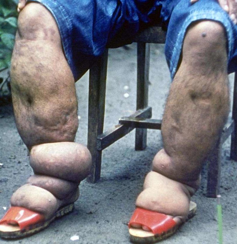 Elephantiasis: Causes, symptoms, and treatment