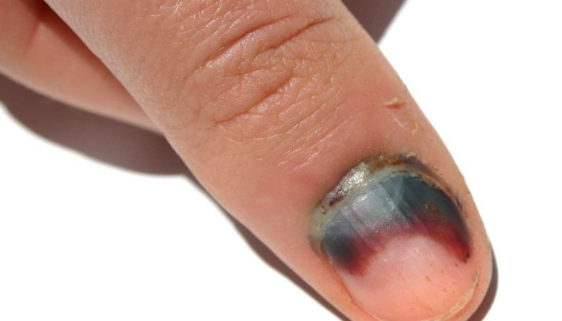 White Spots on Nails: Causes and Treatment Options