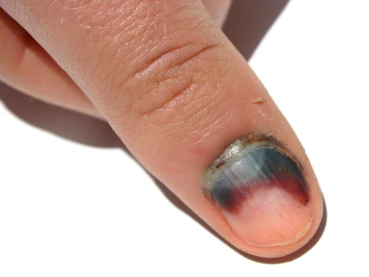 How Your Fingernails Can Show Signs of Disease