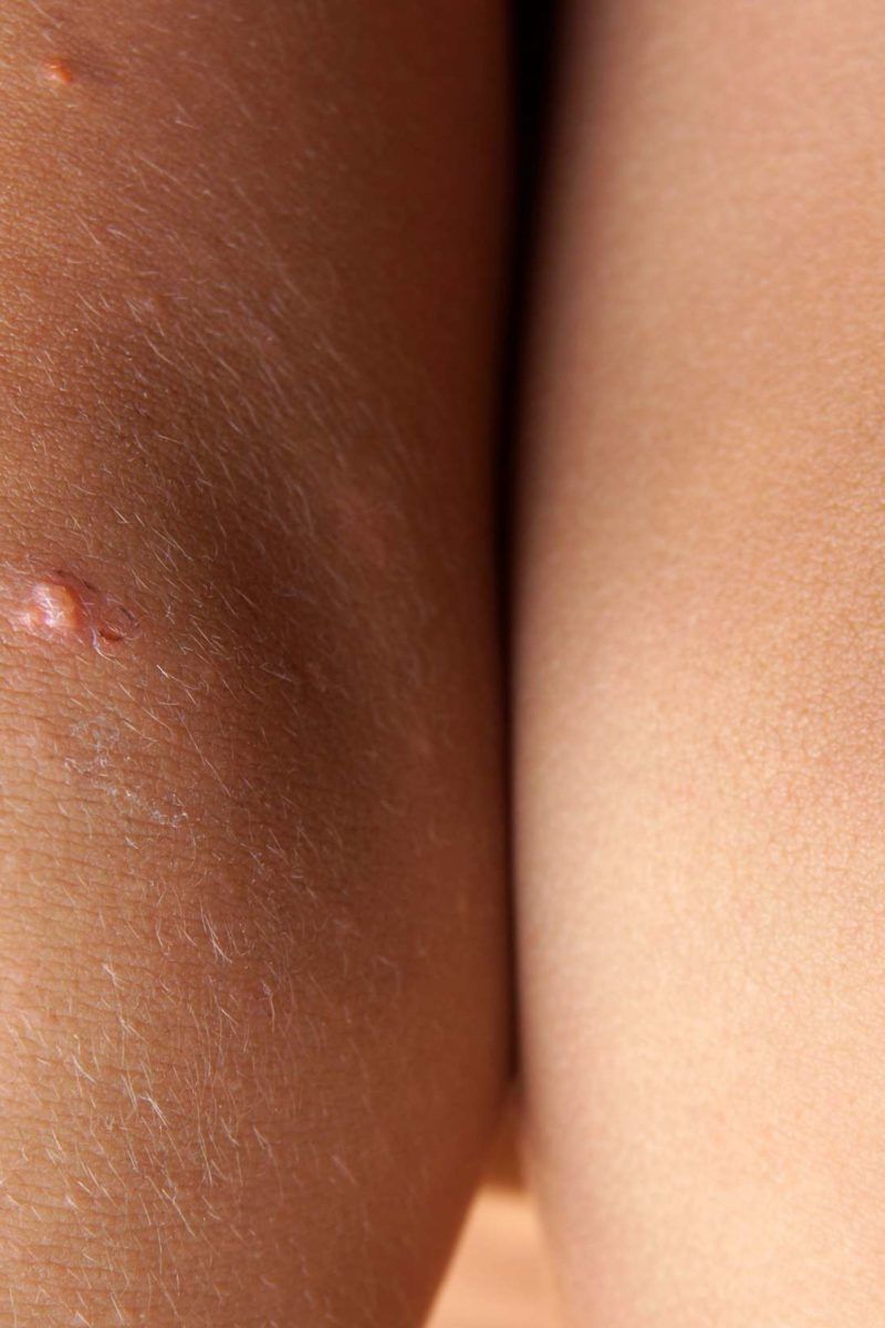 Pimples on legs: Causes and treatment