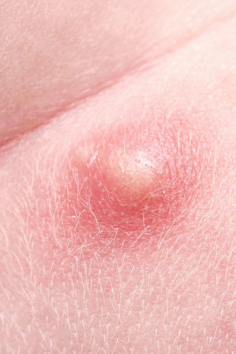Pimple on scrotum: Causes, types, and when to see a doctor