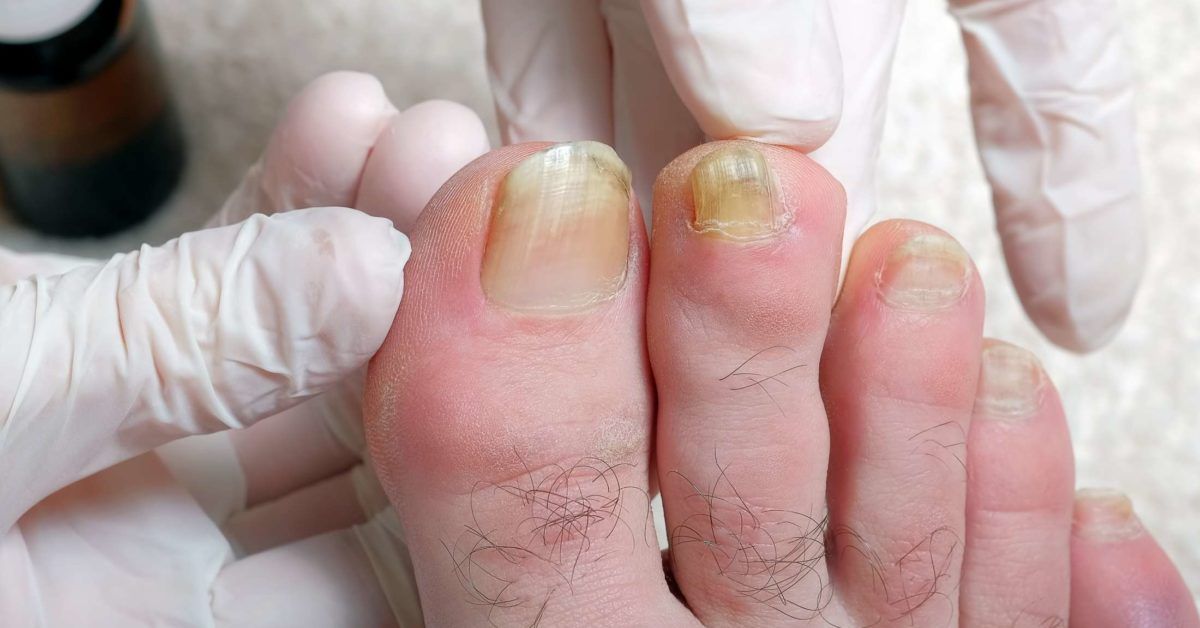 Why are my toenails yellow Causes and treatment