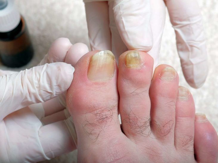 Combat Fungal Nails with Expert Care - My FootDr.